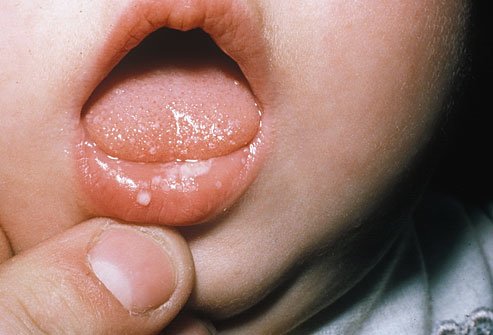 простуда на губах у ребенка